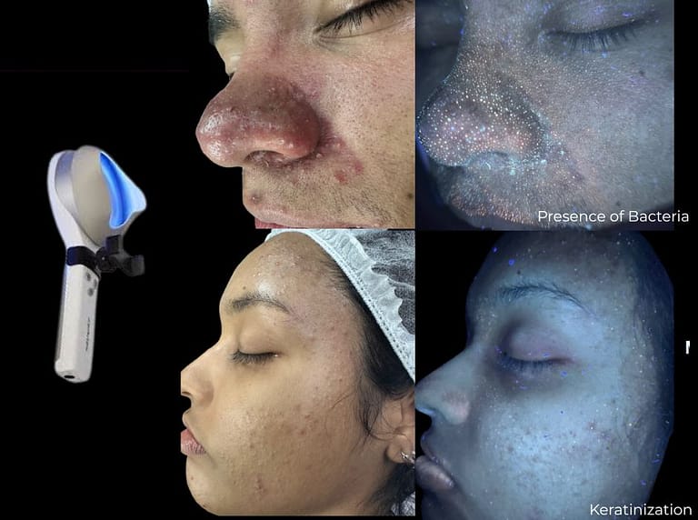 Wood lamp skin analysis Barrie - Jeune et Jolie Medispa